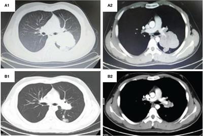 Application of Anlotinib Combined With Neoadjuvant Chemotherapy in Primary EWS/PNET of Lung: A Case Report